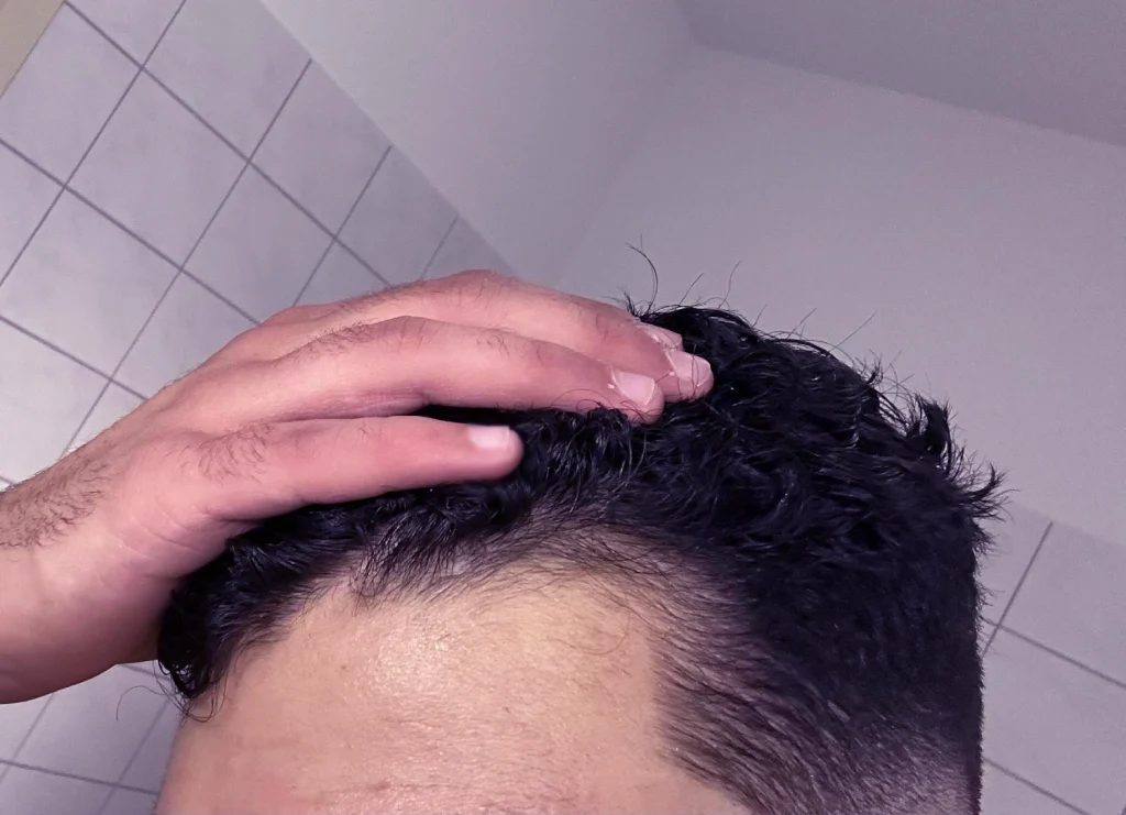 Wie Steroide zu Haarausfall beitragen 1 Mein Haar nach 3 Steroidzyklen (Mann in den 30ern)